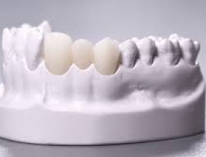 Răng Toàn sứ Cercon Đức