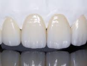 Răng sứ cao cấp Zolid