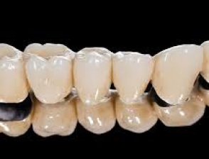 Răng sứ kim loại caramco