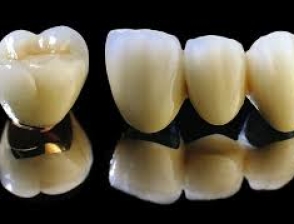 Răng sứ Titan - vita Đức