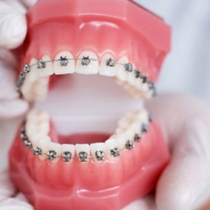 nieng-rang-cao-lanh-uy-tin-nha-khoa-ben-thanh