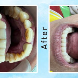 giai-phap-khac-phuc-rang-ho-vau-ban-da-biet-dau-la-lua-chon-phu-hop-chua-1-1