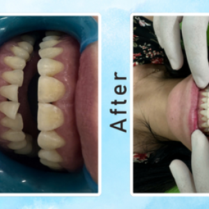 khach-hang-cao-voi-rang