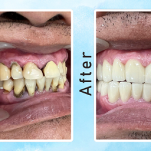 giai-phap-khac-phuc-rang-ho-vau-ban-da-biet-dau-la-lua-chon-phu-hop-chua-1-1-1-1