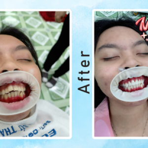 khach-hang-dieu-tri-rang-tham-my